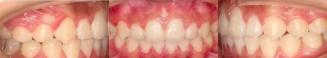 Intraoral photographs showing alignment after 24 months of fixed orthodontic treatment