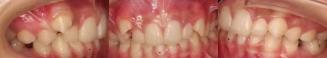 Intraoral photographs before treatment, showing severe crowding and ectopic eruption
